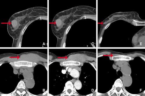 Figure 2 CT images of the masses in the right breast and chest wall. Before treatment (A–D): (A) There was a well-defined slightly high-density mass in the right breast (arrow). (B) An ill-defined iso-density mass ís shown in the chest wall (arrow). The masses in the breast (C) and the chest wall (D) show homogeneous and mild enhancement on enhanced CT images (arrow). After treatment (E and F): the masses of the breast (E) and chest wall (F) disappeared (arrow).