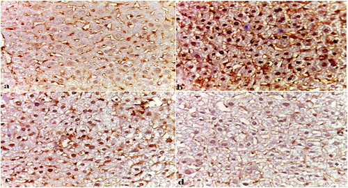 Figure 12. Photomicrographs showing PCNA immuno-expression in (a) negative control, (b) HCC control, (c) HCC+IQ [10 mg/kg bw] -treated and (d) HCC+IQ [20 mg/kg bw]-treated groups. Negative control section shows weak nuclear PCNA immunoreaction, while HCC control section shows strong positive nuclear immunoreaction. HCC+IQ [10 mg/kg bw]-treated group shows moderately positive nuclear immunoreaction, while HCC+IQ [20 mg/kg bw]-treated group shows positively mild nuclear immunoreaction.