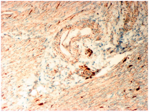 Figure 2. Immunohistochemistry analysis of VEGF Expression in the myometrium of patients with chronic pelvic pain caused by adenomyosis. A weak reaction to MAT for VEGF in the cytoplasm of smooth myocytes and intense reaction in the cells of the perivascular compartment. IHC MAT to VEGF, original magnification  200×.
