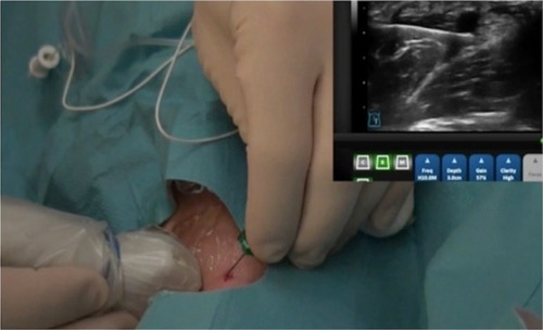 Figure 1 A view from a video recording presented to the MG to aid procedure characterization. Views are from the operative procedure and ultrasound output.