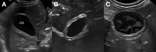 Figure 2. Ultrasound images of gallbladder wall thickening in dogs with hypoalbuminemia. (A) A mild and diffuse homogeneously hyperechoic gallbladder wall thickening is present. This dog was diagnosed with lymphoma. (B) A mild and diffuse gallbladder wall thickening with a 3-layer appearance. There are thin inner and outer hyperechoic layers and a central hypoechoic layer. This dog was diagnosed with hepatic metastatic carcinoma. (C) A mild and diffuse gallbladder wall thickening with a 3-layer appearance. Hyperechoic lacy striations are present within the central hypoechoic layer. This dog was diagnosed with the caudal vena cava obstruction due to neoplasia associated thrombosis with hepatic congestion and ascites.