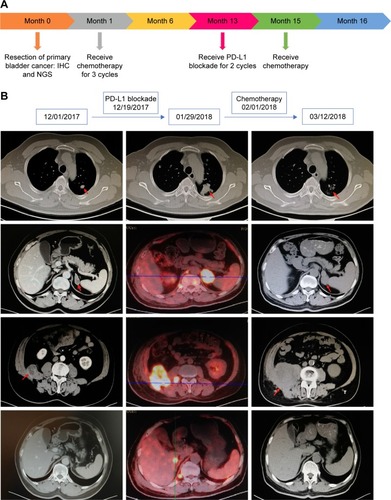 Figure 1 Treatment intervention process and imaging of disease progress after PD-L1 blockade.