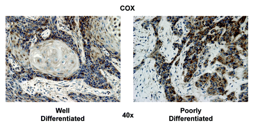 Figure 6. COX mitochondrial activity staining in well-differentiated and poorly differentiated HNSCC specimens. In well-differentiated, note that carcinoma cells in the periphery of nests have high COX activity (brown), while as differentiated cells in the center of nests have low COX activity. In poorly differentiated, note that carcinoma cells in the nests diffusely stain strongly for COX. Note also that the tumor stroma is negative COX staining. Original magnification: 40×, as indicated.