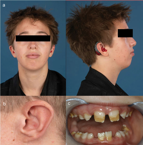 Figure 3. Mild craniofacial dysmorphic features and amelogenesis imperfecta in adults with mild Zellweger spectrum disorder (ZSD). Patients with comparatively mild ZSD had varying degrees of.
