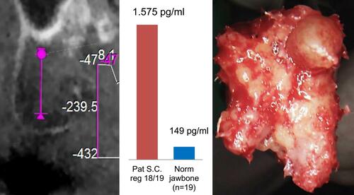 Figure 7 Left image shows DVT/HU of the retromolar area 18/19 with −239,5 Center image shows the R/C expression of the intraoperatively taken bone sample, which is about ten-fold higher than healthy jawbone. Thus, a chronic inflammatory process in the area of 18/19 has been confirmed by multiplex laboratory analysis. Right picture shows the fatty-degenerated cancellous bone from area 18/19, which structurally corresponds to the HU attenuation coefficient of −239. Related histologic findings in area 18/19 are: internal medullary spaces with myxoid or fibrillar degeneration of fatty tissue; trophic disorders.