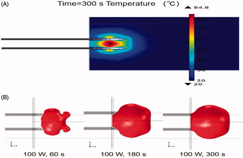 Figure 2. (A) Temperature distribution in liver tissue determined using FEM simulation with a water-cooled double-needle MW ablation device. (B) Evolution of 50 °C isothermal surface in a liver tissue determined with FEM simulation using the double-needle MW ablation.