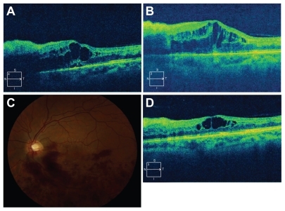 Figure 2 Cirrus spectral domain optical coherence tomography progression. (A) Best corrected visual acuity 20/60, improved intraretinal and subretinal fluid (central foveal thickness 534 microns) after initial intravitreal bevacizumab injection four weeks earlier. (B) Best corrected visual acuity 20/70, central foveal thickness 682 microns. (C) Color fundus photograph six weeks after third intravitreal bevacizumab injection. Improved confluent macular hemorrhage. (D) Best corrected visual acuity 20/40, central foveal thickness 473 microns, corresponding optical coherence tomography to (C) visit.