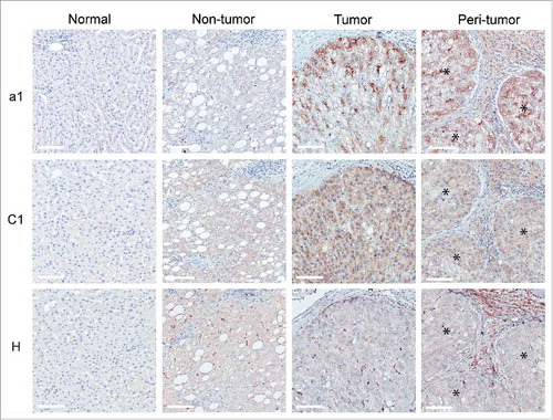 Figure 4. Expression pattern of V-ATPase subunits in liver tissues. The immunohistochemical expression of a1, C1 and H V-ATPase subunits was evaluated in normal and matched non-tumor, tumor and peri-tumor liver tissues. Peri-tumor tissues were identified as areas adjacent to tumor nodules enriched in immune infiltrating cells. The membranous/cytoplasmic expression of a1 and C1 subunits was detected in malignant hepatocytes. The H subunit was mainly expressed in the Kupffer cells present in non-tumor and tumor tissues. The a1 and H subunits were also expressed by infiltrating immune cells in the peri-tumor areas of the liver. *Identifies a tumor area in the peri-tumor sections. Representative images with scale bars = 100 μm.