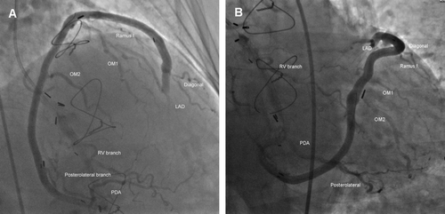 Figure 2.  Snake graft post-PCI images annotated to show all eight target vessels. (A) RAO cranial view. (B) AP caudal view. Owing to the length and size of the graft complete opacification of both the proximal and distal segments could not be achieved simultaneously.