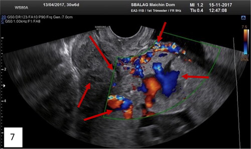 Figure 7. Transvaginal ultrasound of total placenta previa (anterior and posterior) with many ultrasound markers, including the new marker intracervical lakes on Gray-scale; on Color Doppler of the lower uterine segment: bridging vessels, loss of clear space, lacunae with turbulent blood flow inside, feeder vessels and analyzing phenomenon, intraplacental hypervascularity, and intravascular lakes (red arrows).