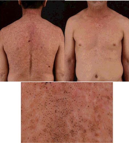 Figure 3. Chloracne lesions on trunk. Comedone-like lesions combined with skin color anomaly on trunk.