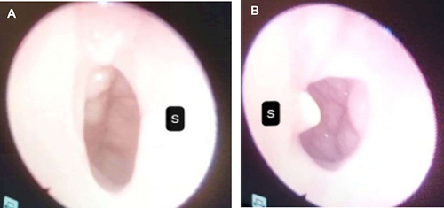 Figure 5 Eight-month postoperative endoscopic image of the choana (A) Right nasal passage (B) Left nasal passage S: Septum.