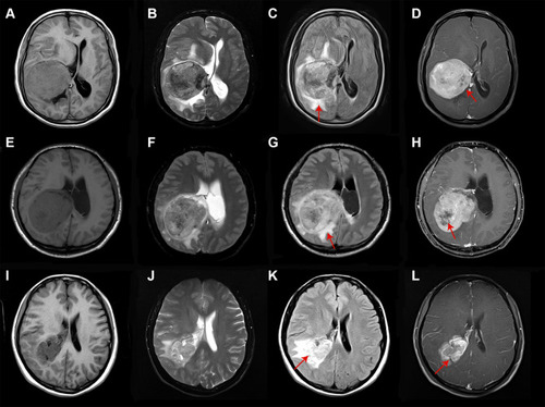 Figure 1 MRI images of typical WHO I (A–D), WHO II (E–H) and WHO III (I–L) of LVM. Most MRI images show mixed-intense and heterogeneous enhancement. Typical low-grade LVM is relatively more regular and clearer boundary, while high-grade LVM has more obvious peritumoral edema and tissue infiltration. Heterogeneous enhancement and perifocal edema in which MRI sequences are indicated by arrows.