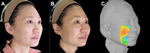 Figure 10 A 49-year-old female whose main complaint was mid-facial ptosis and the appearance of jowl fat. The two-step fat repositioning procedure was performed. (A) Preoperative 3D photograph; (B) 3 months post-operative photograph; (C) 3-dimensional color map of the mid-cheek and jowl regions depicting volume change at 3 months.