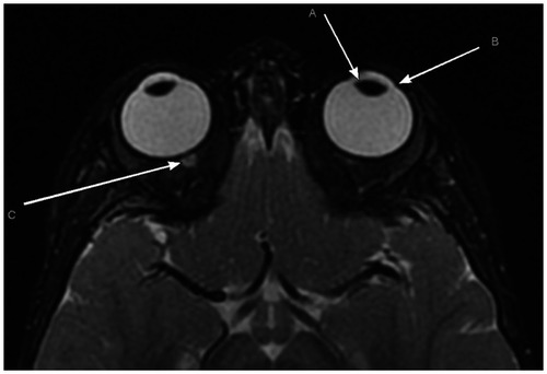 Figure 5 Axial T2WI from a normal orbital MR in an aged-matched patient demonstrating a normal oval lens morphology, the normal angle of the limbus, and a normal optic nerve-sheath complex. (A) Normal oval lens morphology; (B) normal angle of the limbus; (C) normal optic nerve-sheath complex.