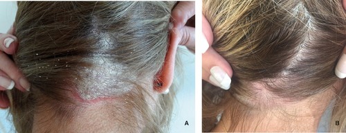 Figure 2 Case 2: (A) before and (B) after treatment for 4 weeks with calcipotriol (50 µg/g)/betamethasone dipropionate (0.5 mg/g) aerosol foam.