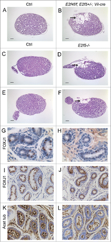 Figure 5. Dilation of the rete testis is observed at one week of age in E2f4f/f;E2f5+/−;Vil-cre and E2f5−/− testes and loss of E2F5 reduces the multiciliated cell population. (A) Sagittal sections of testis from one week old control (Ctrl) and (B) E2f4f/f;E2f5+/−;Vil-cre mutant testis showing extensive dilation of the rete testis in the mutant (arrow). (C) Sagittal sections of testis from one week old control (Ctrl) and (D) E2f5−/− mutant testis showing extensive dilation of the rete testis in the mutant (arrow). (E) Sagittal sections of testis from 3 week old control (Ctrl) and (F) E2f5−/− mutant testis showing dilation of the rete testis (arrow) and partial dilation of seminiferous tubules in the mutant. (G) Immunohistochemical staining for FOXJ1, a multiciliated cell marker in one week old control and (H) E2f5−/− mutant efferent ducts showing reduced expression in the mutants. (I) Immunohistochemical staining for FOXJ1 in 3 week old control and (J) E2f5−/− mutant efferent ducts showing reduced expression in the mutants. (K) Immunohistochemical staining for acetylated tubulin staining (brown stain) of cilia shows many multiciliated cells in efferent ducts from 3 week old controls but many fewer multiciliated cells in littermate E2f5−/− mutant efferent ducts. Panels A though F hemotoxylin and eosin stained sections. Scale bars: E and F 400 μm; A, B, C, D 200 μm; I, J, K and L 20 μm; G and H 5μm.