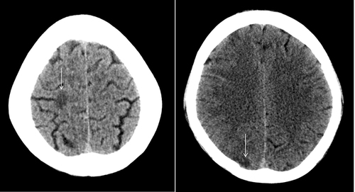 Figure 1 The Left part is showing axial CT scan of the brain which shows right parietal subcortical white matter hypodensity (arrow). Right: Fig Axial CT scan of the brain shows right frontal subcortical white matter hypodensity (arrow).