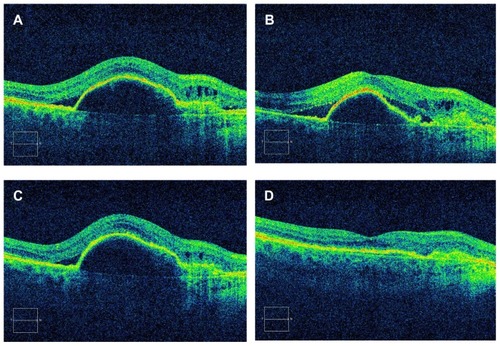 Figure 2 Sequential optical coherence tomography scans of patient’s right eye show worsening subretinal fluid and an expanding retinal pigment epithelial detachment despite 6-monthly injections of bevacizumab (A) and (B). After one injection of aflibercept 2 mg, the subretinal fluid had decreased (C), and after the second injection of aflibercept, the subretinal fluid had resolved and the retinal pigment epithelial detachment had completely flattened (D).