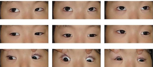 Figure 2 Case 1: ptosis, hypotropia, and exotropia in the patient’s left eye.