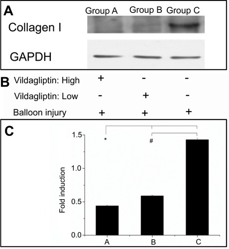 Figure 5 Western blot of collagen I content (A). After balloon injury, various groups with stents loaded and not loaded with vildagliptin-eluting nanofibers, or without stents (B). Relative expression of each protein was quantified by densitometry as a ratio of density to that of corresponding GAPDH (C). Each value is presented as mean ± SE. (*# p<0.001 group A or B versus group C in post hoc analysis.