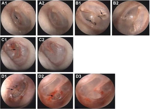 Figure 1 The typical cases of all kinds of membrane perforation.