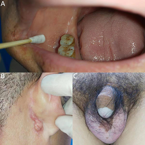 Figure 2 Skin and mucous membrane pictures of the patient. (A) On the right side of the oral cavity, close to the opening of the parotid duct, light-yellow millet-sized flat papular lesions were visible in the buccal mucosa, which were clustered and fused into dense irregular patches. Their surface was smooth, and there was a sand-like sensation when touching them. (B) A sebaceous cyst was observed behind the right ear. (C) There were vitiligo skin lesions on scrotum and glans of the patient.