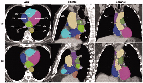 Figure 2. Comparison of auto-segmented contours (solid lines) and modified contours (colorwash) for patients (a) and (b) in the axial, sagittal and coronal views. LA: left atrium; LV: left ventricle; RA: right atrium; RV: right ventricle; SVC: superior vena cava; IVC: inferior vena cava; PA: pulmonary artery; PV: pulmonary vein; DA: descending aorta; AA: ascending aorta.