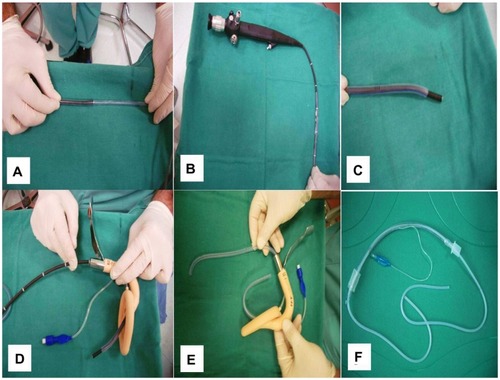 Figure 3 (A) Laryngeal steel handle mask. (B) Levin tube. (C) Ambu face mask. (D) Levin tube with the edges cut off. (E) Bronchoscope. (F) Endotracheal tube.