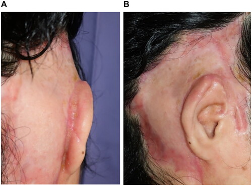 Figure 6. At 7 months after reconstructive surgery. (A) The auricular temporal sulcus is clear. (B) The shape of the auricle is good.