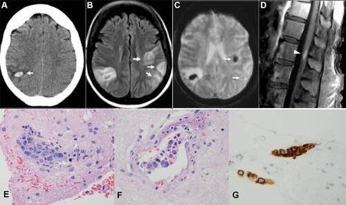 Figure 1 (A) Axial non-contrast CT on readmission showing acute right parietal intraparenchymal hemorrhage (short white arrow) with mild surrounding edema. (B) Axial T2-FLAIR MRI obtained the next day shows new abnormalities in the left hemisphere (short white arrows). (C) Associated intraparenchymal hemorrhages (short white arrows) on the axial T2* GRE MRI. (D) Abnormal linear enhancement in the conus medullaris (arrowhead). The hematoxylin and eosin (H&E) stained section of brain biopsy shows focal intravascular infiltrate of neoplastic large lymphocytes ((E) and (F), ×40); and they are positive for CD20 by immunohistochemistry study (IHC) ((G), ×40), which confirms the B cell lineage of the lymphoma.