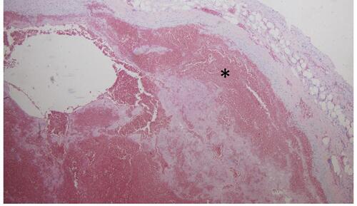 Figure 7 Histological section (hematoxylin eosin staining) of a patient with intramural hematoma. Hematoma (asterisk) within the aortic media is well documented.