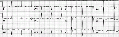 Figure 1. ECG tracing from a patient with an anterior-septal infarct with no Q-waves in the precordial leads.