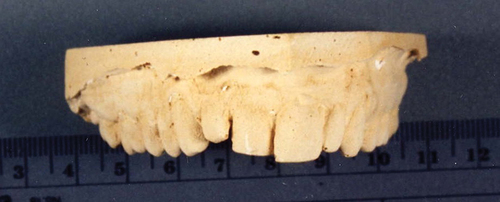 Figure 2. Dental Model from Ray Krone