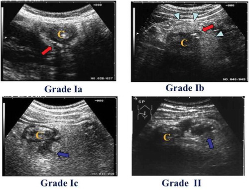 Figure 1. Classification of ACD on the basis of US. The severity of ACD was classified into two grades. Grade Ia: an inflamed diverticulum (arrow). “C” indicates colon. Grade Ib: an inflamed diverticulum (arrow) with pericolitis (arrow head). Grade Ic: an inflamed diverticulum with abscess formation of ≤ 2 cm in diameter (arrow). Grade II: an inflamed diverticulum with abscess formation of > 2 cm in diameter (arrow) or with perforation.
