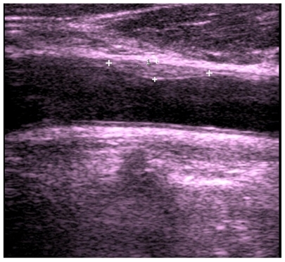 Figure 2 Longitudinal sonogram shows the presence of a soft hypoechoic carotid plaque in anterior wall of common carotid artery (CCA).