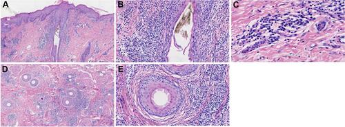 Figure 2 Histopathological findings in a vertical section showing (A) hyperkeratosis and mild epidermal hyperplasia (HE×40), (B) epithelial basal layer destruction of the hair follicle with surrounding infiltration of dense lymphocytes and histiocytes (HE×200); (C) significant plasma cell infiltration (HE×400); Horizontal section showing (D) partial destruction of hair follicles (HE×40); (E) only the structure of the arrector pill remains (HE×200).