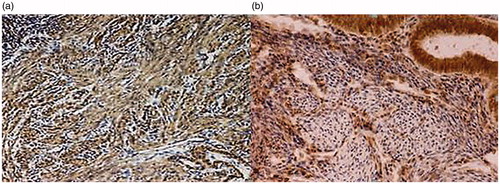Figure 1. Group I (adenomyosis with PP). Myometrium (IHC Method: antibodies to OTR, counterstaining with hematoxylin, increase ×40). (а) Myometrium section; (b) adenomyosis focal area.