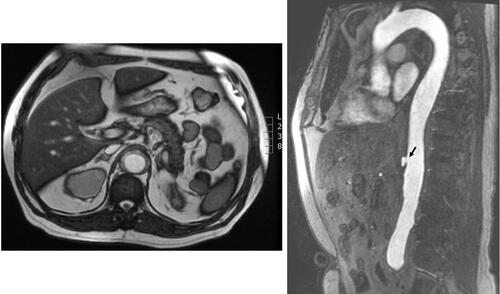 Figure 6 Magnetic resonance images (echo-gradient sequence, axial and sagittal views) showing intramural aortic hematoma. An ulcer-like projection is observed at the abdominal aorta (arrow).