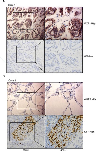 Figure 2 Expression of JAZF1 and Ki67 in PTC tissue samples. (A and B) Two typical examples show the relationship between JAZF1 and Ki67 expression. The left sides represent 200× amplification, the right sides represent 400× amplification.
