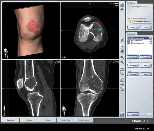 Figure 1. CT and MR images for Case 2 were fused in the navigation system and the tumor delineated from the fused image datasets. The tumor volume (outlined in red) can be calculated, enabling an estimate of the amount of bone cement or artificial bone graft required to fill the bone defect after intra-lesional curettage. The locations of working portals were planned and marked by virtual pedicle screws.