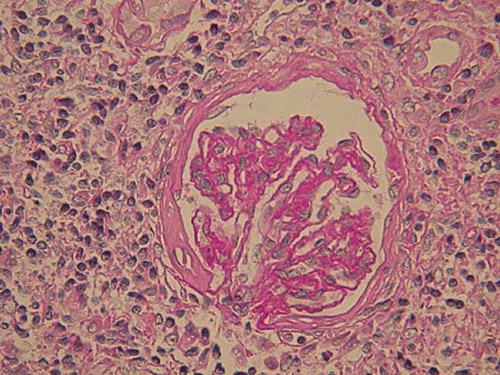 Figure 3. Light microscopy of a glomerulus with ischemic change as well as areas of interstitial infiltration and severe degenerative tubular lesions (periodic acid-Schiff stain, original magnification ×400).