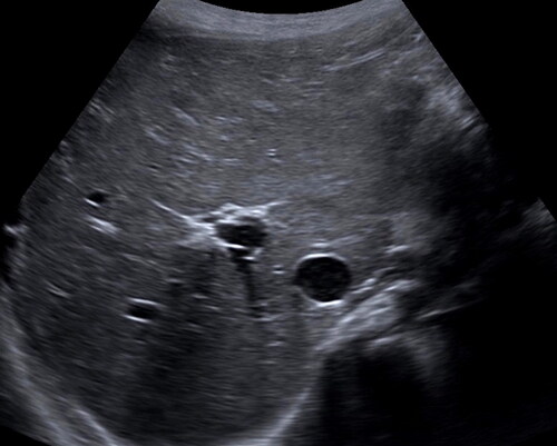 Figure 5. Abdominal sonography. Representative sagittal image of the liver demonstrates echogenic foci with posterior acoustic shadowing in the peripheral hepatic dome, compatible with portal venous gas. On follow up the next day, this finding had resolved.