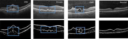 Figure 6 Edge detection results of the fundus with four disease types respectively (the upper four images are the original image, and the lower four images are the automatically detected edge images. It can be clearly seen that some blur contours and disease features are highlighted which increases intuitiveness and interpretability of the model. Detection edge can help us process effective information purposefully and ignore unimportant information. CNV means choroidal neovascularization, DME means diabetic macular edema).
