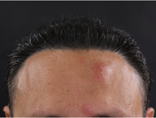 Figure 1 Lesions consistent with herpes zoster in the ophthalmic division of the left trigeminal nerve distribution.
