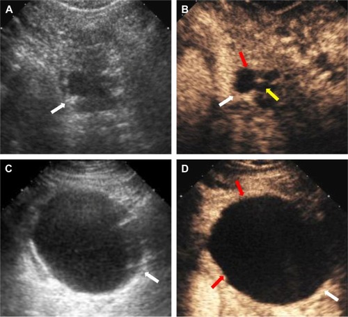 Figure 2 Serous cystadenoma diagnosed via surgical pathology from the pancreatic body–tail in a 42-year-old-woman (A, B), and a mucinous cystadenoma diagnosed via surgical pathology from the pancreatic tail in a 55-year-old woman (C, D).