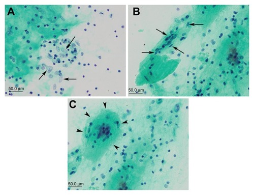Figure 2 Vitreous cytology for case 1 with sarcoidosis. (A) Histiocytes (arrows), (B) epithelioid cells (arrows), and (C) multinucleated giant cells (arrowheads) can be seen.