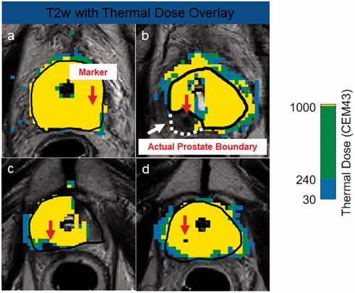 Figure 4. Case examples demonstrating different effects markers can have on thermal dose. Marker centers are shown with red arrows. Despite the presence of a gold marker, the thermal dose extends to the prescribed boundary (a). The large susceptibility artifact caused by the nitinol marker forced the user to move the target boundary (black) inside the actual prostate boundary (white), due to high temperature uncertainty (b). After focal treatment of patient’s right lobe, which was drawn outside the prostate capsule to include the neurovascular bundle, undershoot is caused by the gold marker located 9.1 mm from the urethra center and 14 mm from the target boundary. A gold marker situated close to the urethra center (12.4 mm) but far from the target boundary (13.5 mm) impeded the ultrasound wave resulting in poor thermal dose delivery inside the prostate (d).