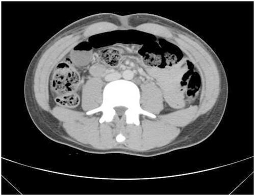 Figure 1 Enhanced abdominal CT taken on day 14. Part of the intestine was dilated and there was gas and fluid accumulation, and the gas-liquid level was visible.