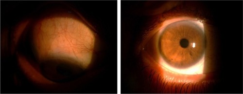 Figure 8 Three months after surgery: coapted sclera flap and no bleb.